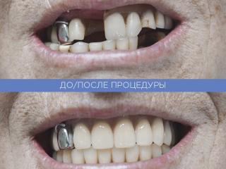 Зуб Литой Фото